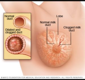 How To Relieve A Clogged Milk Duct