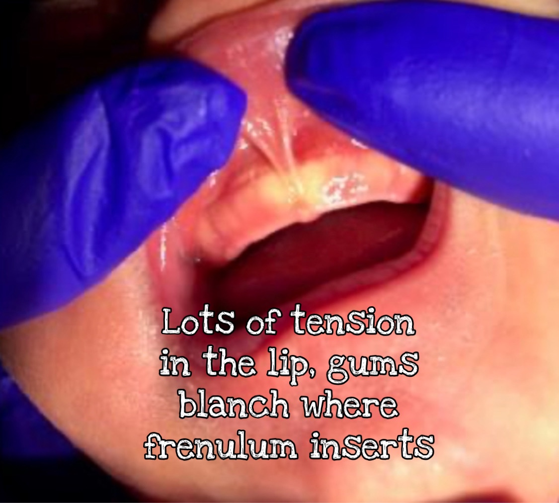 labial frenulum normal