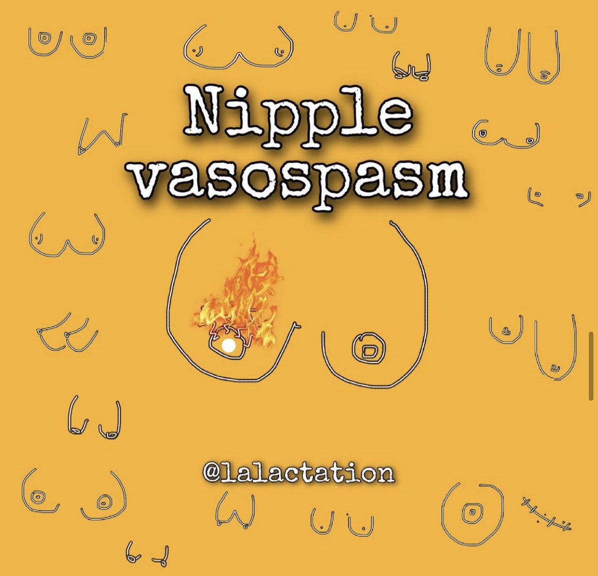 Extremely Sore Nipples? Nipples Changing Colour After Breastfeeding? Could  it Be Vasospasm?